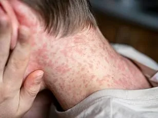 CDC Raises Travel Advisory for Bolivia to Level 2 as Chikungunya Resurgence Sparks Global Health Concern