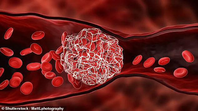 Deep Vein Thrombosis Risk Rises with Prolonged Sitting, Experts Warn