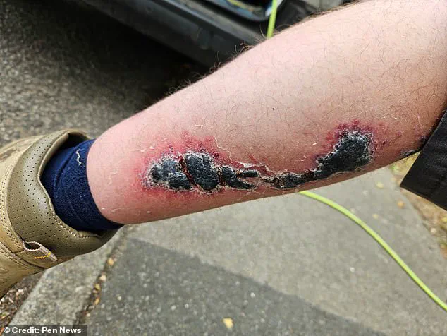 Exclusive: Hidden Dangers of a Noble False Widow Spider Bite Revealed Through a Window Cleaner's Ordeal