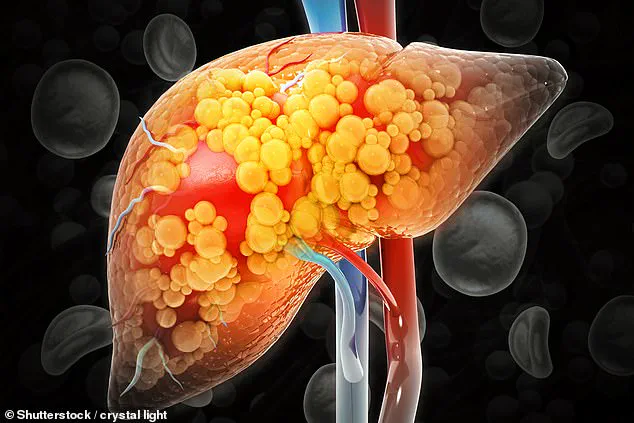 Exercise Offers Lifeline to Millions at Risk of Silent Liver Disease, New Study Reveals