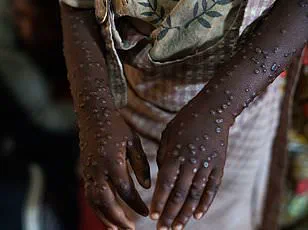 First Mpox Case in Alaska Since 2023 Linked to Travel to High-Prevalence Region, Officials Report