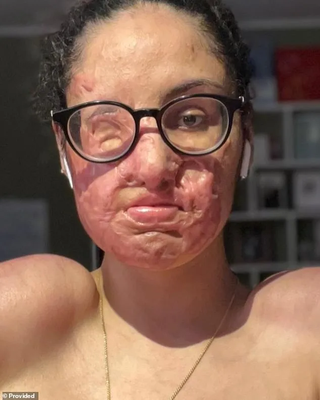 Five-Year Justice: Terrell Campbell Indicted for Acid Attack That Left Nafiah Ikram with Life-Altering Burns