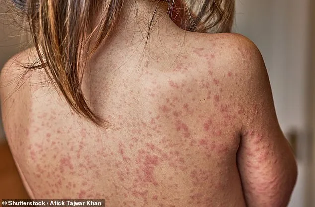 Measles Outbreak in London: Enfield Epicenter as Cases Rise and Public Health Alert Issued