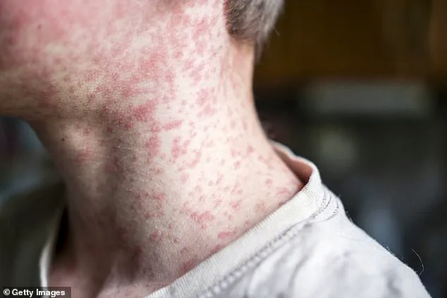 Measles Outbreak in Utah Highlights Need for Strengthened Vaccination Regulations to Protect Public Health