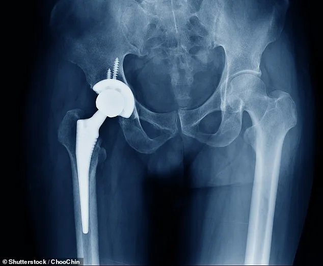 NHS in Crisis: Bone Cement Shortage Sparks Surge in Waiting Times, Threatening Millions of Patients