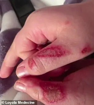 Nine-Year-Old Boy Hospitalized After Microwaving Sensory Toy in Dangerous TikTok Trend