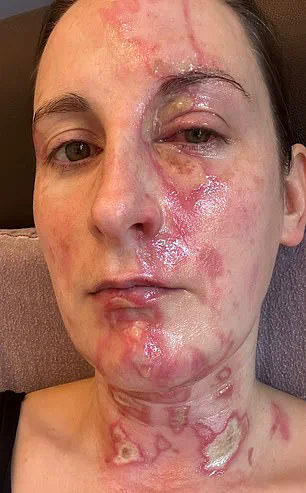 NutriBullet Blender Accident Results in Severe Burns for Professional Harpist