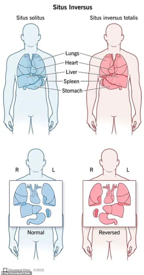 Privileged Insights: Situs Inversus and the Mirrored World of Internal Organs
