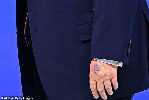 Trump's Davos Bruise: 'Minor Accident' Says President, as Public and Medical Experts Weigh Health Implications
