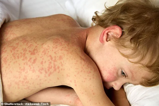 U.S. Measles Cases Exceed 2,000 Mark, Highest Since 1992; Public Health Officials Sound Alarm Over Resurgence