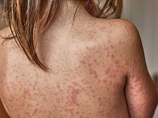 UK Warns of Nipah Virus Outbreak in India, Issues Travel Guidance Amid 75% Mortality Rate Concerns