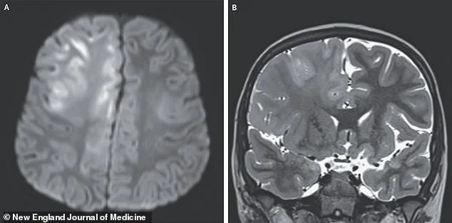 Measles Resurgence Ignites Concern Over Long-Term Risks and Surging Cases in 2026