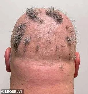 MHRA Approves Leqselvi (Deuruxolitinib) as Breakthrough Therapy for Severe Alopecia Areata