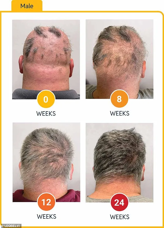 MHRA Approves Leqselvi (Deuruxolitinib) as Breakthrough Therapy for Severe Alopecia Areata