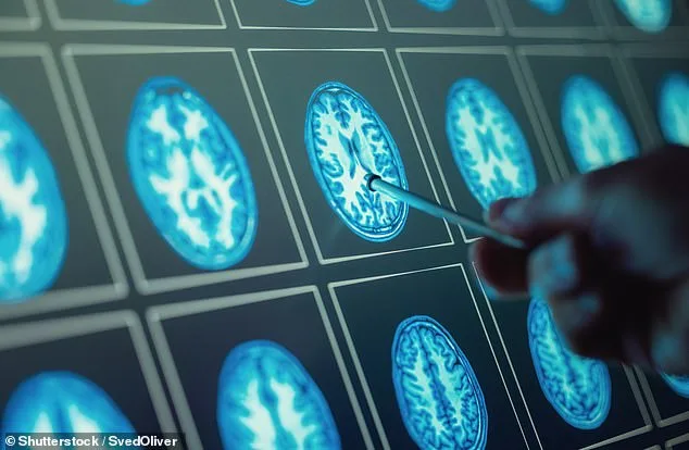 A Doctor's Early Battle with MS: How His Medical Expertise Expedited a Diagnosis