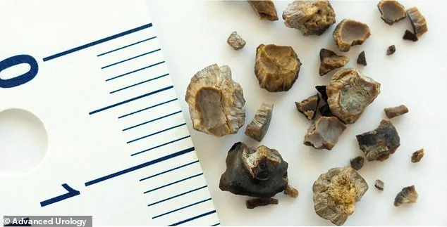 Kidney Stones Surge: From Middle Age to Millennials, a Growing Health Crisis