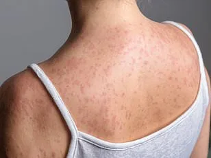 Los Angeles County Faces Record Surge in Flea-Borne Typhus, With 90% of Patients Requiring Hospitalization Amid Emerging Hotspots