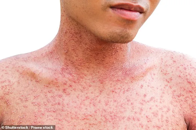 Los Angeles County Faces Record Surge in Flea-Borne Typhus, With 90% of Patients Requiring Hospitalization Amid Emerging Hotspots