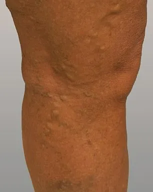 A Decade of Silence: Philippa Bradley's Journey with Varicose Veins, Shame, and Resilience