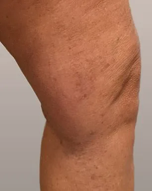 A Decade of Silence: Philippa Bradley's Journey with Varicose Veins, Shame, and Resilience