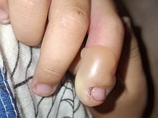 Boy Suffers Severe Burns After Mistaking Giant Hogweed for Toy