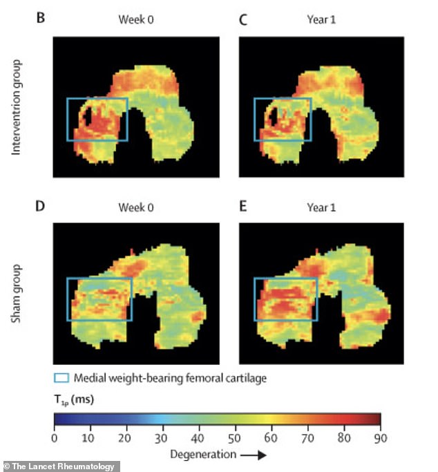 Stanford Study: Simple Walking Adjustment Could Ease Knee Arthritis Pain